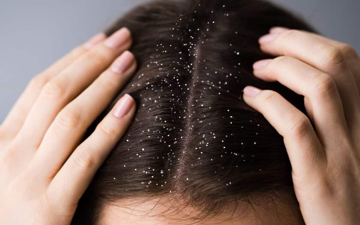 A dermatite seborreia atormenta a vida de inúmeras pessoas, você pode ser uma das vítimas e nem faz ideia disso; entenda como funciona.