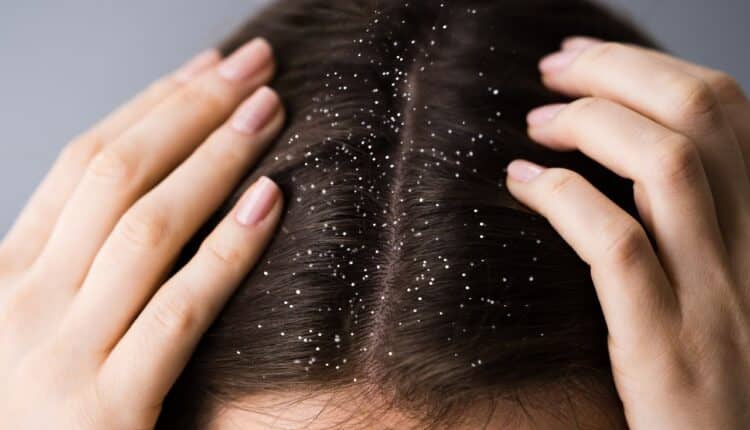 A dermatite seborreia atormenta a vida de inúmeras pessoas, você pode ser uma das vítimas e nem faz ideia disso; entenda como funciona.